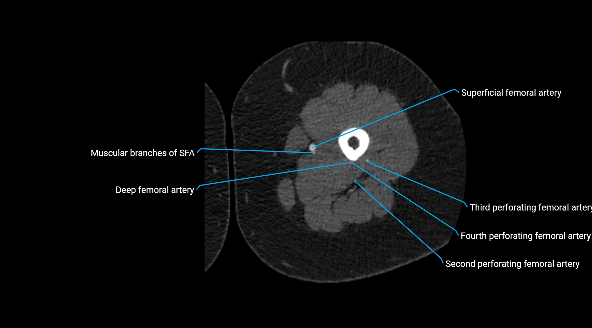 CTA lower limb cross sectional anatomy labelled image _124.webp